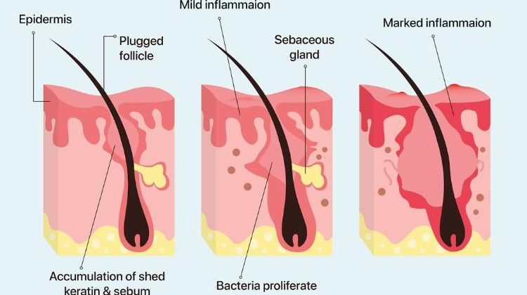 Cara Mengatasi Purging Retinol Tanpa Khawatir
